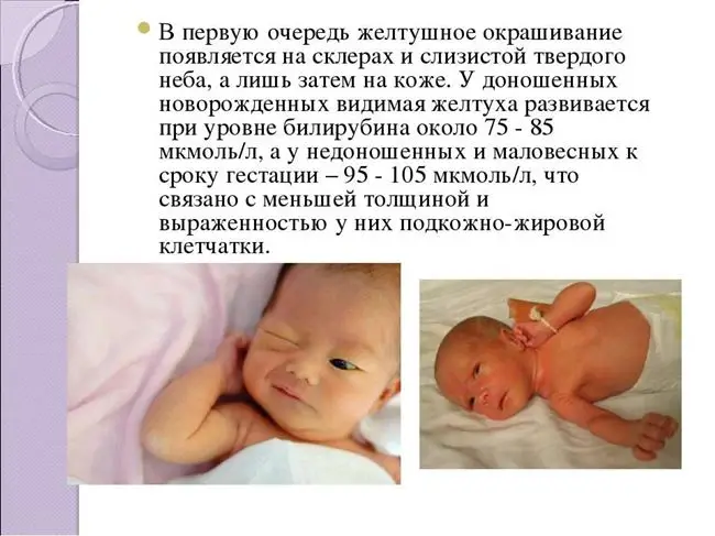 Причины возникновения желтухи новорожденных