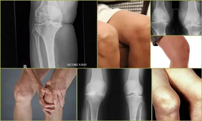 Признаки артроза коленного сустава 