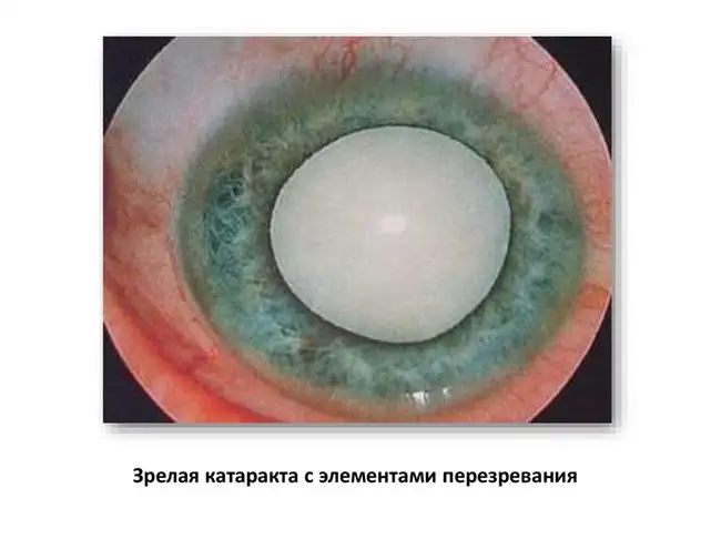 При ослаблении зрения, катаракте (на начальной стадии), воспалении, изъязвлении роговицы, гипертонии