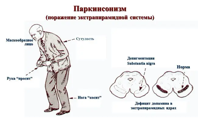 Откуда берется болезнь Паркинсона, причины возникновения