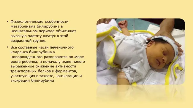 Лечение желтухи новорожденных