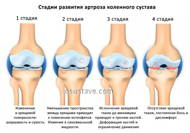 Признаки артроза коленного сустава